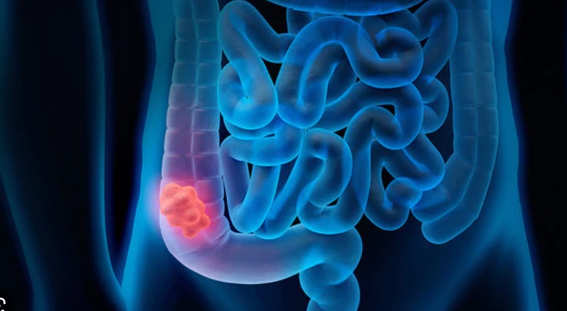 Grande scoperta dell’Università di Milano – Trovato il ‘punto debole’ del tumore al colon “Ora è curabile”